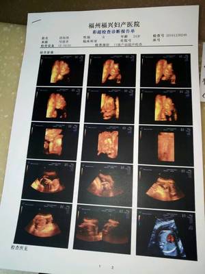 四维顺利通过，喜接男宝！分享在福州福兴妇产医院的温馨体验